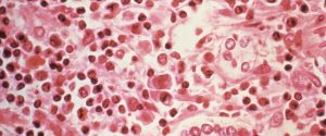 Hantavirus