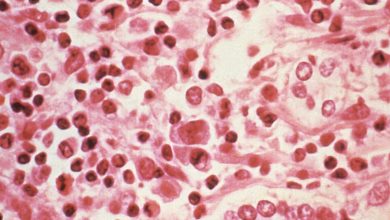 Hantavirus