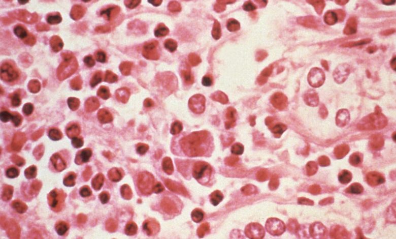 Hantavirus